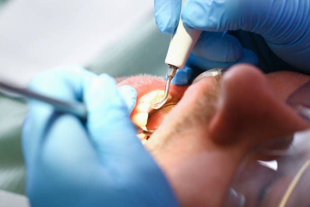 Best Knocked-Out Tooth (Avulsed Tooth) Treatment in Strodes Mills, PA