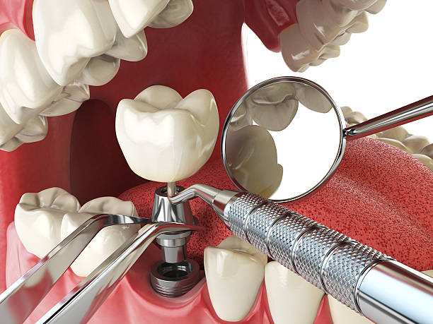 Best Knocked-Out Tooth (Avulsed Tooth) Treatment in Strodes Mills, PA